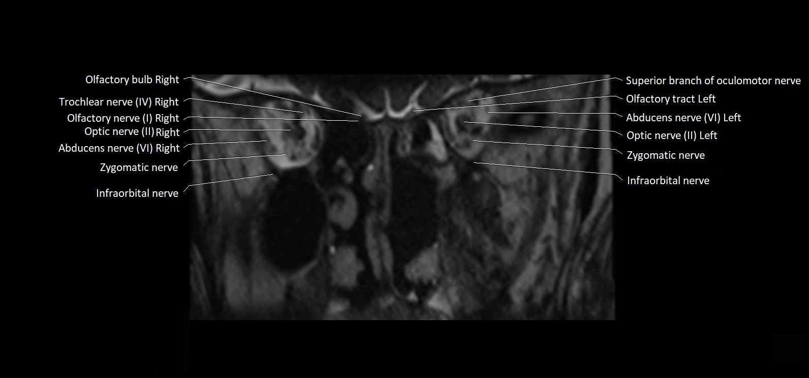 Cranial nerve cross sectional anatomy coronal 3T MRI image 10.webp